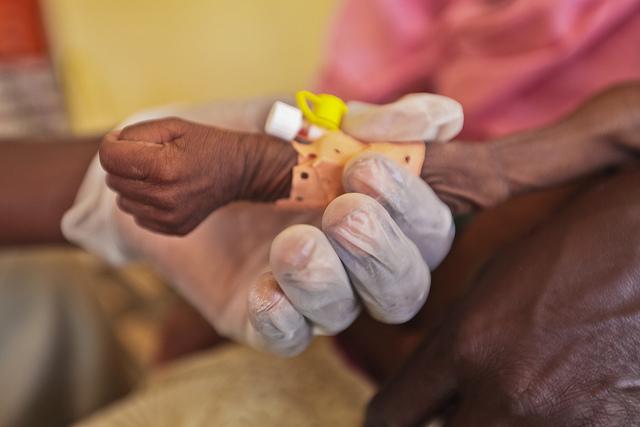 Kwashiorkor: sintomas, causas, fisiopatologia e tratamento 5