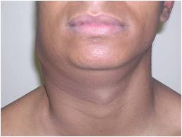 Tuberculose linfonodal: sintomas, causas, tratamento 23