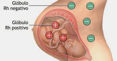 Isoimunização Fetal Materna: Fisiopatologia, Tratamento 1