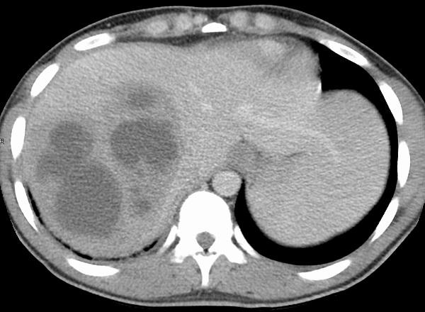 Abscesso hepático: sintomas, causas, tratamentos 19