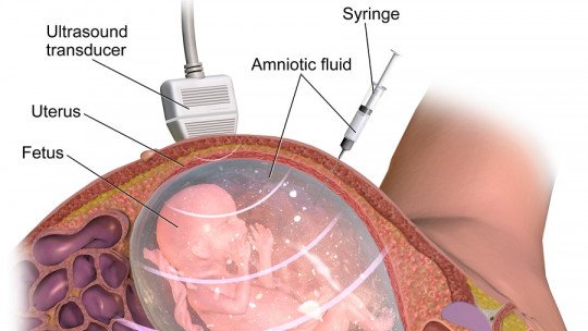 Amniocentese: o que é e como é realizado esse teste diagnóstico 1