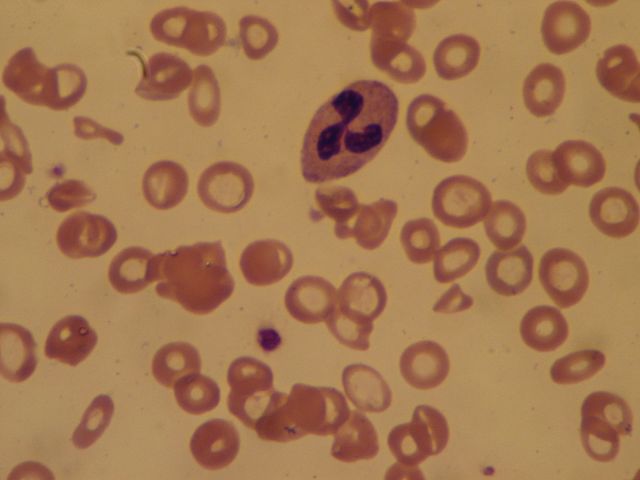 Baixa hemoglobina: sintomas, causas e tratamentos 3