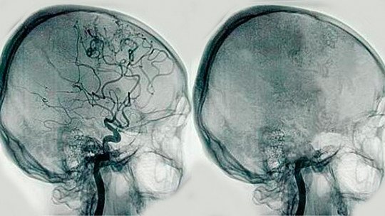 Angiografia cerebral: o que é e quais distúrbios ele pode detectar? 1