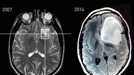 Astrocitoma: tipos, sintomas, causas e tratamento 1