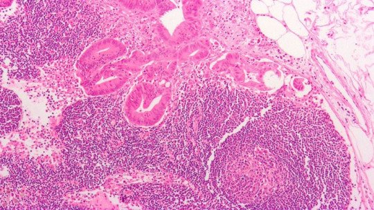Câncer de cólon: 8 sintomas de alerta 1