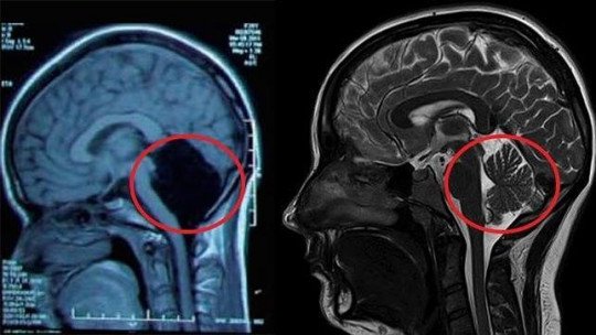 O caso incomum de uma mulher sem cerebelo que surpreendeu a comunidade científica 1