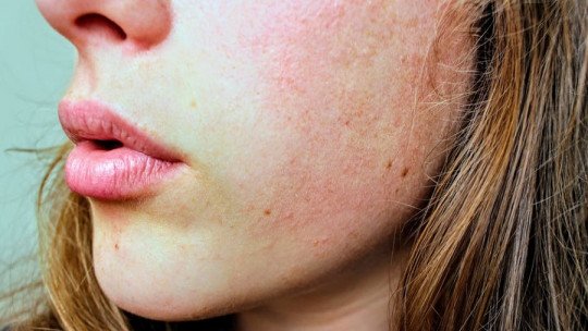 Como remover cicatrizes de acne: 8 dicas 1