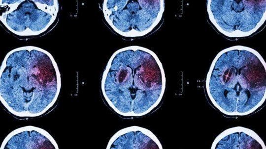 Curso: definição, causas, sintomas e tratamento 1