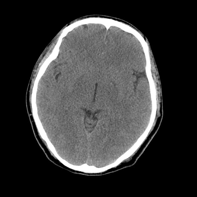Encefalopatia hipóxica: sintomas, causas e tratamento 1