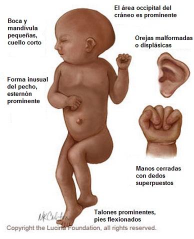 Síndrome de Edwards: características, sintomas, causas 2