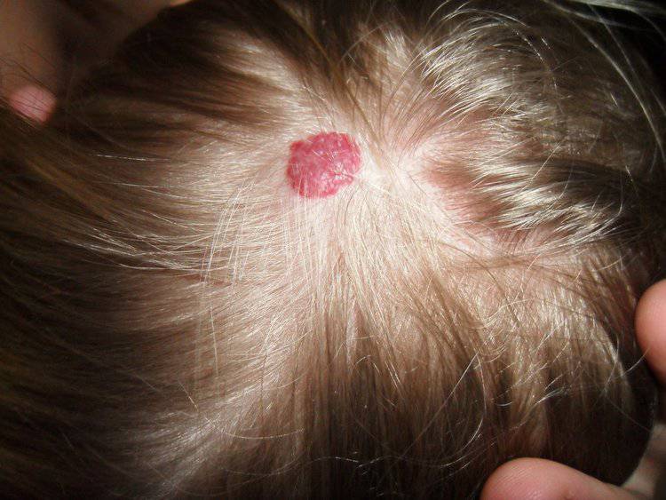 Hemangioma cerebral: sintomas, causas, tratamento 1