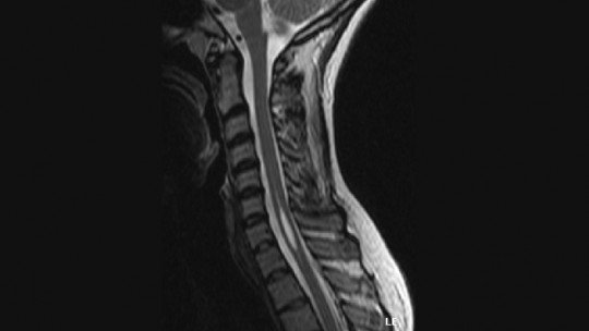 Siringomielia: sintomas, causas e tratamento 27