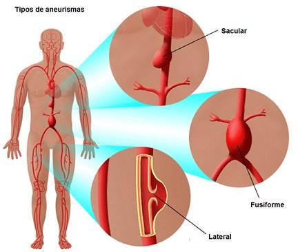 Hemorragia subaracnóidea: sintomas, causas e tratamento 2