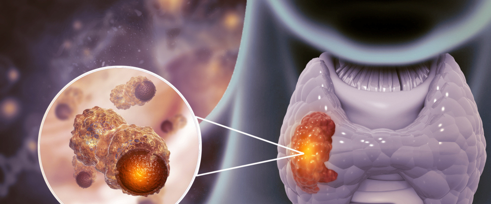 cáncer de tiroides qué es