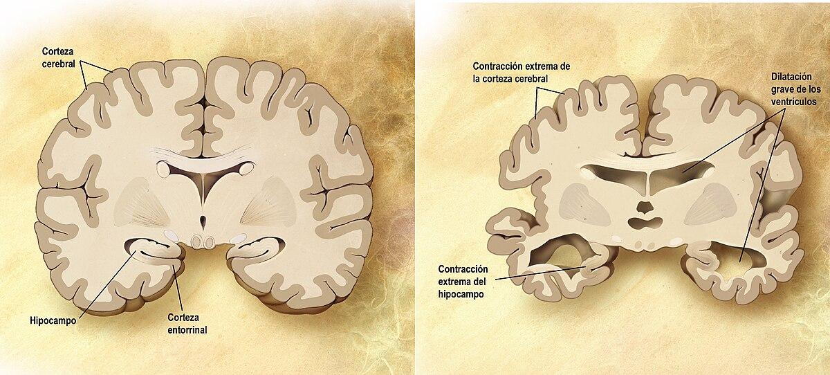 Segni tardivi dell'Alzheimer