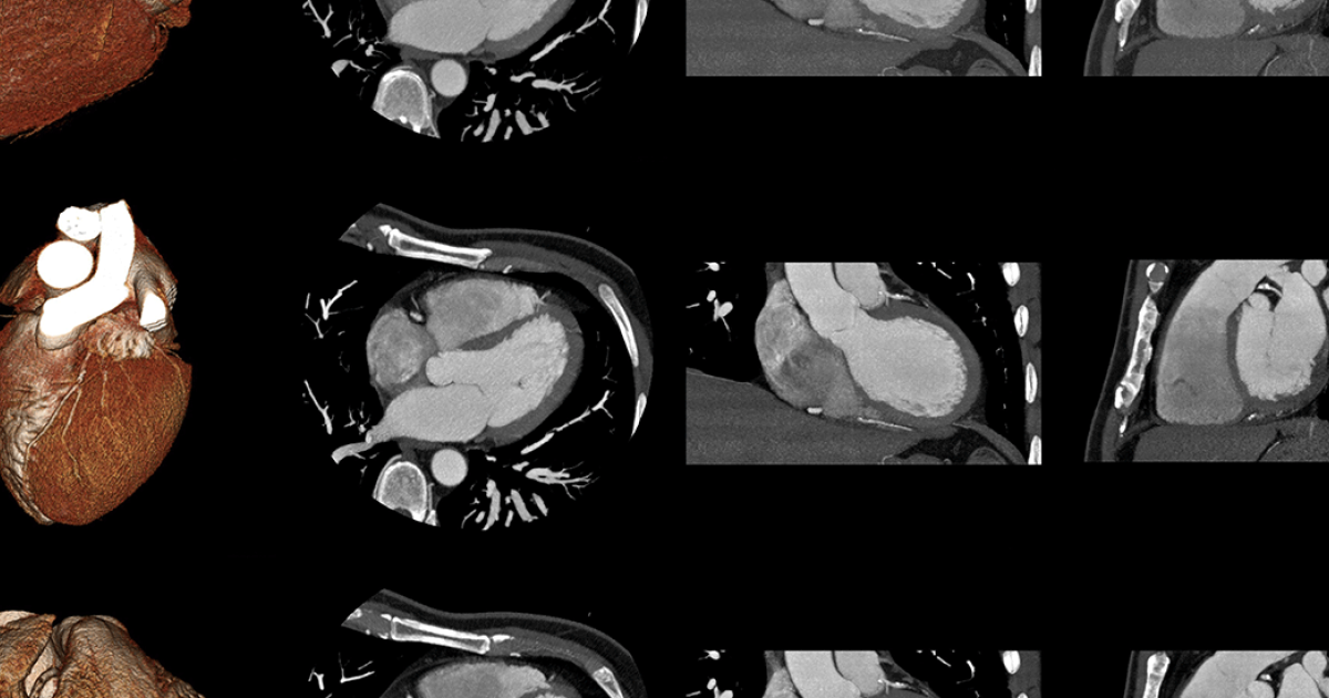 doenca das valvulas cardiacas doenca das valvulas cardiacas