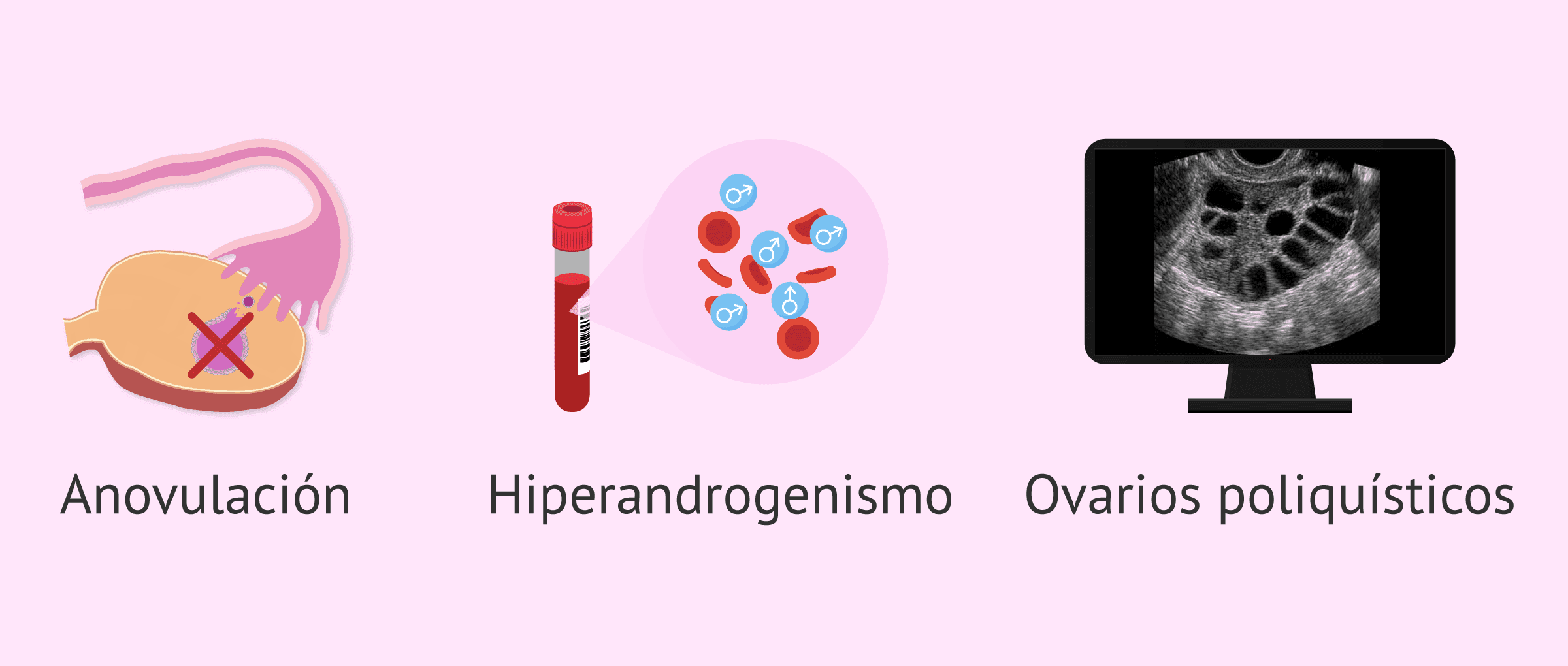 sindrome ovarios poliquisticos y trastornos urinarios sindrome ovarios poliquisticos y trastornos urinarios