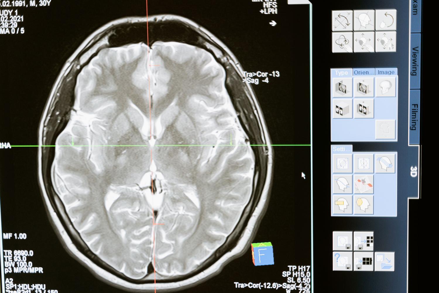 Imagen de un escaneo cerebral MRI en una pantalla de ordenador, simbolizando el uso de la magnetoencefalografía (MEG) y la ciencia neurológica.