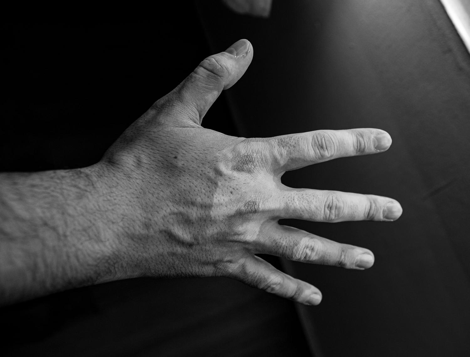 Imagen artística en blanco y negro de una mano con vitiligo, destacando el contraste tonal de la piel.