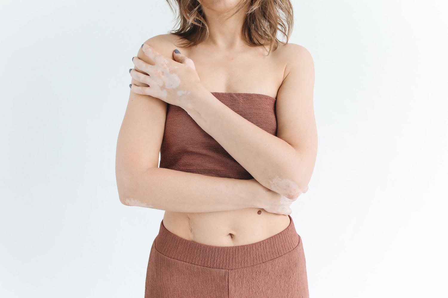 Mujer con vitiligo abrazando su piel con confianza, mostrando la belleza natural y la aceptación.