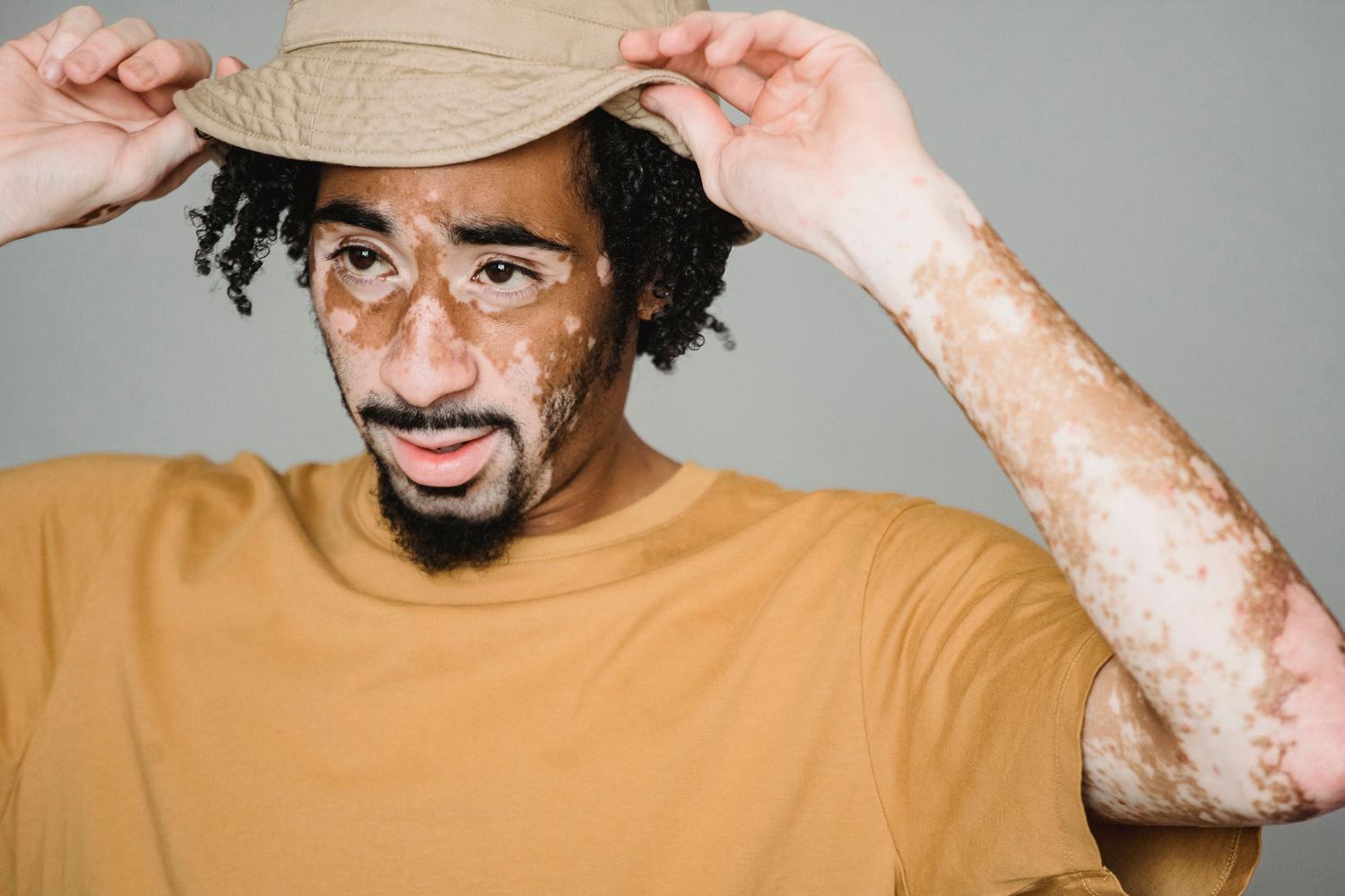 Joven con vitiligo en rostro y brazos posando con naturalidad y confianza.