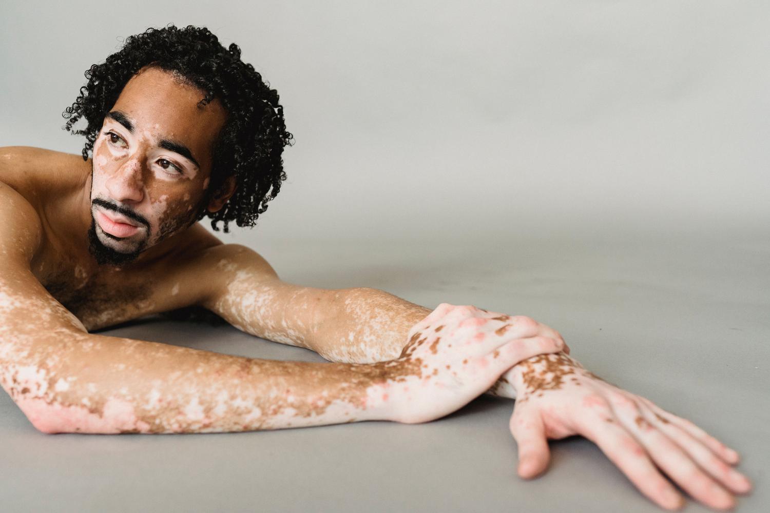 Hombre afroamericano con vitiligo en el torso y rostro, mostrando el alto contraste de la despigmentación.