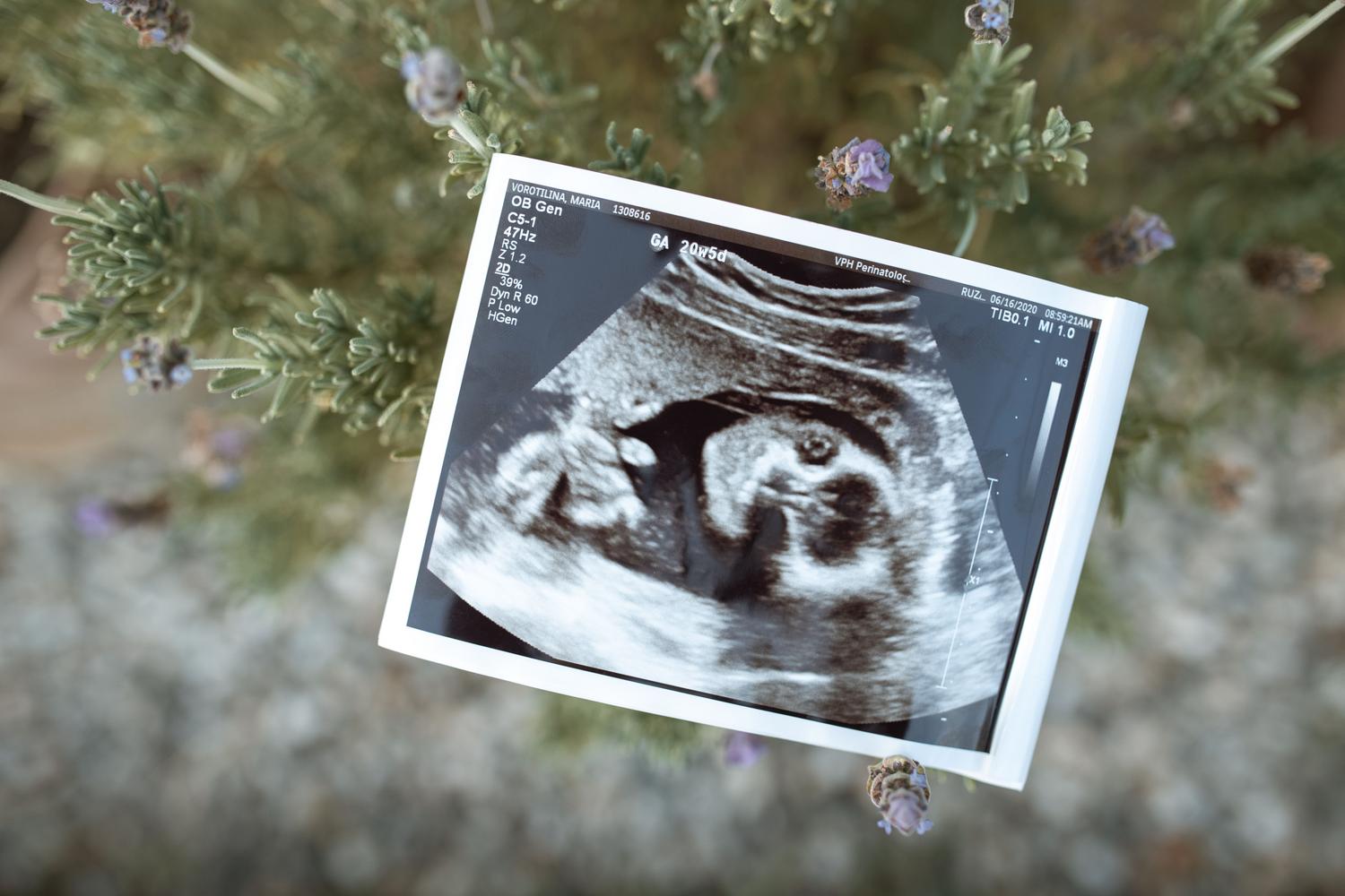 Primer plano de una ecografía fetal sobre un fondo natural, simbolizando el inicio de la vida y el seguimiento médico.