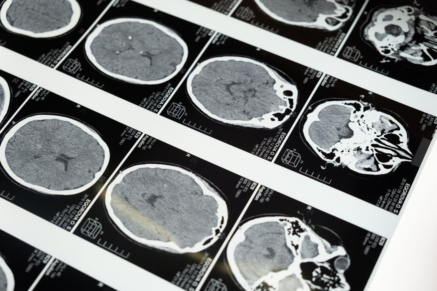 Imágenes detalladas de resonancia magnética (IRM) del cerebro humano mostrando cortes transversales para diagnóstico neurológico.