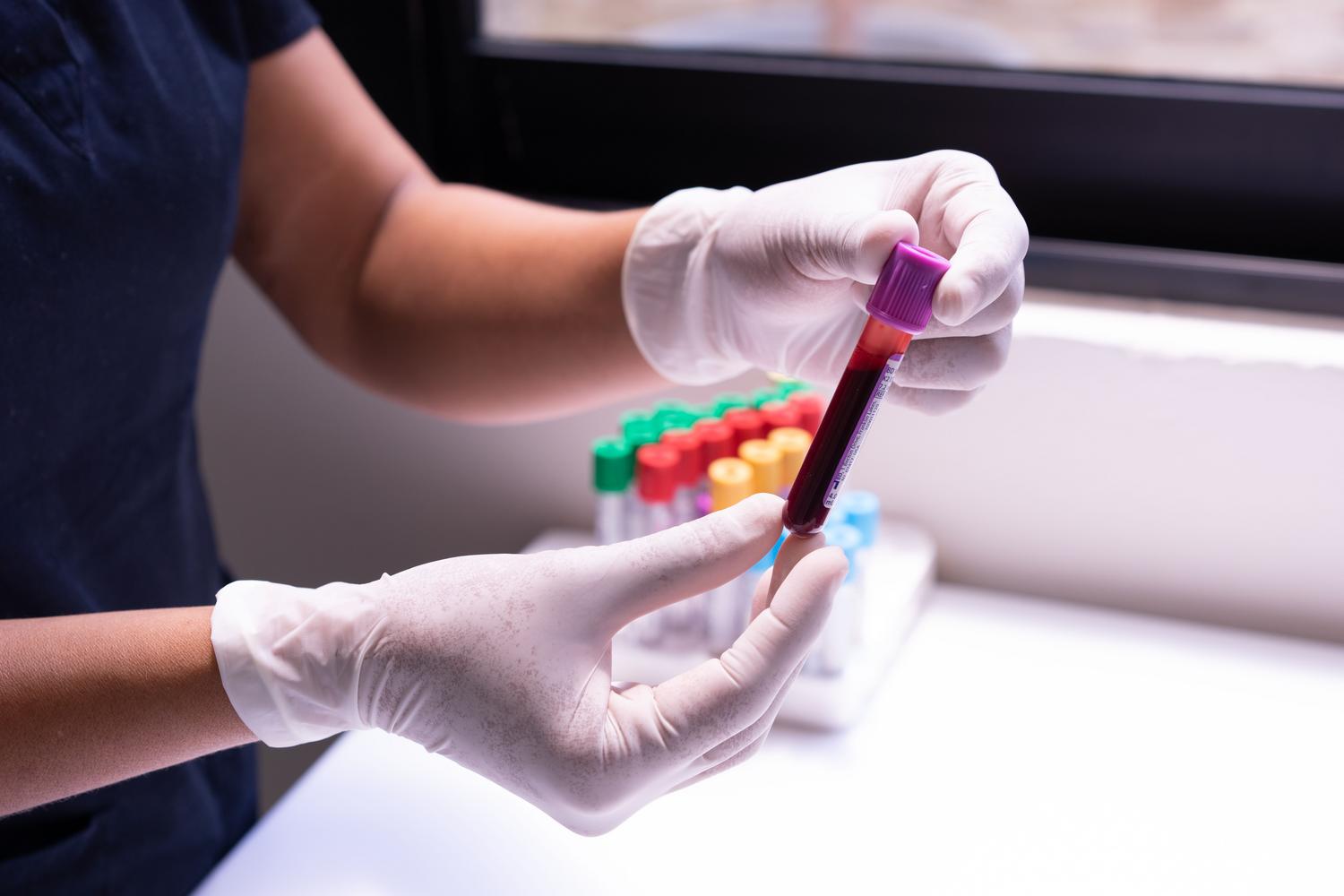 Manos enguantadas manipulando una muestra de sangre en un laboratorio clínico para el análisis de biomarcadores.